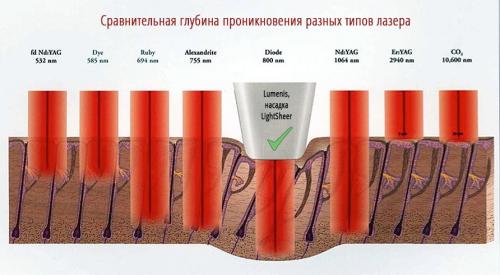 Какие риски и побочные эффекты могут возникнуть после александритового лазера