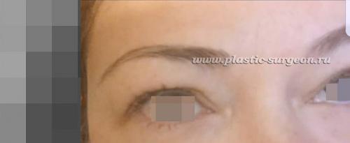 Результат после ботокса через сколько дней виден. Достоинства и недостатки процедуры 03 Результат после ботокса через сколько дней виден. Достоинства и недостатки процедуры 03