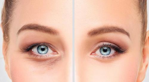 Инъекции под глаза. В каких случаях ботокс для зоны вокруг глаз эффективен? 02