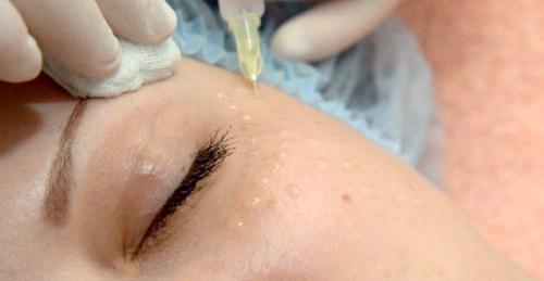 Инъекции под глаза. В каких случаях ботокс для зоны вокруг глаз эффективен? 03