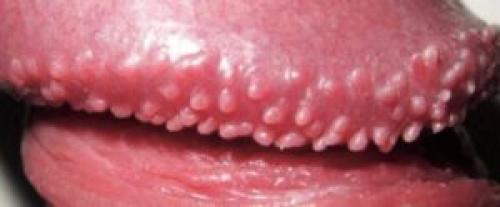 Папула от чего появляется. Перламутровые папулы, или О чем стесняются говорить мужчины?