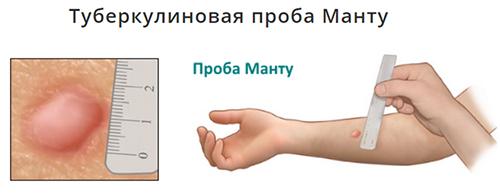 Папула это. Общие сведения