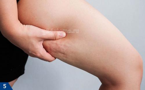 Lpg-массаж до и после. Оптимальные показания к LPG-массажу  –