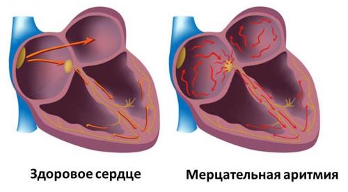 Питание при мерцательной аритмии сердца. Что вызывает приступ? 02 Питание при мерцательной аритмии сердца. Что вызывает приступ? 02
